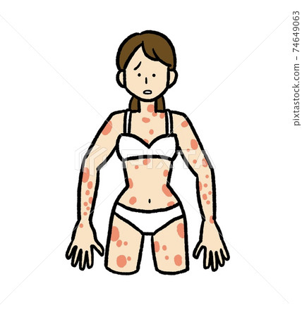 蕁麻疹症狀的女人的插圖 蕁麻疹症狀的女人的插圖 74649063