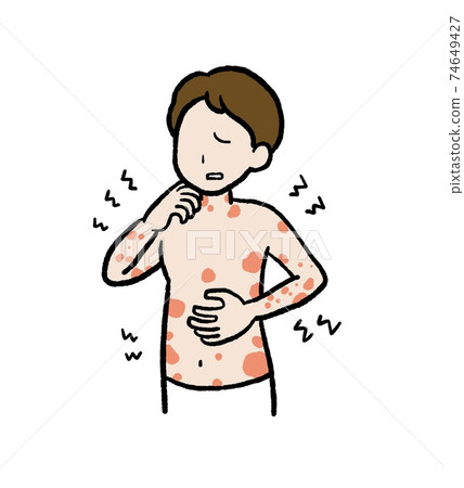 Illustration of a man with urticaria 74649427