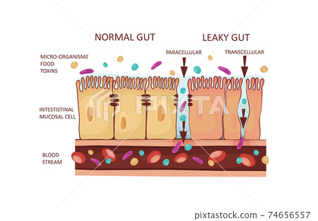 Leaky Gut Syndrome or Intestinal Permeability... - Stock Illustration