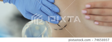Hand in rubber medical glove holds woman's mammary gland with drawn line around closeup 74658937