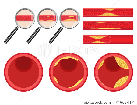 Arteriosclerosis vector design illustration isolated on white background Arteriosclerosis vector design illustration isolated on white background 74665417