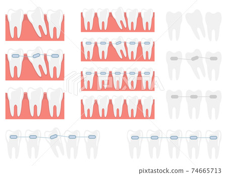 Braces vector design illustration isolated on white background Braces vector design illustration isolated on white background 74665713