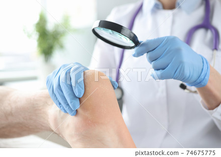 Doctor examining cracks in patients heels using magnifying glass closeup Doctor examining cracks in patients heels using magnifying glass closeup 74675775