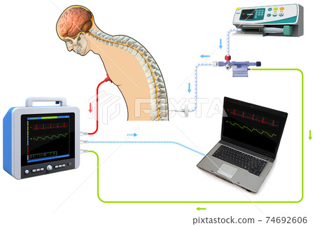 lumbar puncture spinal tap canal diagnostic collect sample patient treat MS tumor, 3D rendering and 2d graphic lumbar puncture spinal tap canal diagnostic collect sample patient treat MS tumor, 3D rendering and 2d graphic 74692606