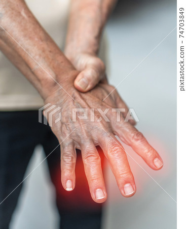 Peripheral Neuropathy pain in elderly patient on hand, palm, fingers and sensory nerves with numb, aching, muscle weakness, stabbing, burning from chronic inflammatory demyelinating polyneuropathy 74703849