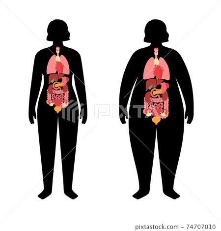 Organs in obese human body Organs in obese human body 74707010