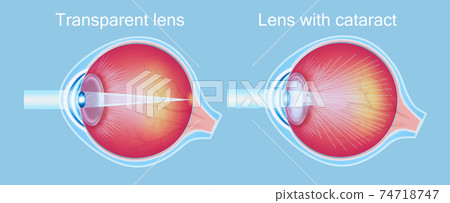 Cataracts and healthy eye detailed structure. Cataracts and healthy eye detailed structure. 74718747