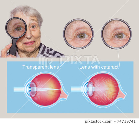 Cataract concept. Senior woman's eye, closeup 74719741