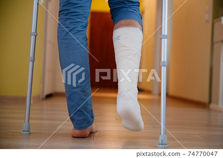 Young man with a broken ankle with a white cast on his leg following a accident. 74770047