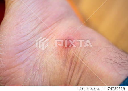 Low temperature burns with a hot water bottle Low temperature burns with a hot water bottle 74780219