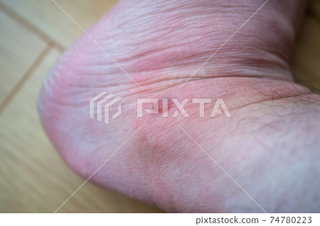熱水袋低溫燃燒 74780223