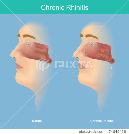 Chronic Rhinitis. This illustration medical use for explain comparison chronic rhinitis symptoms have mucus in the nose and throat. . 74849416