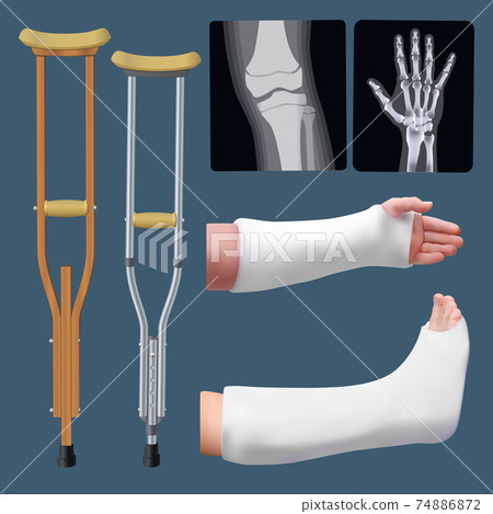 Set of medicine traumatology objects. Treatment of bone fracture. Plaster splint, crutch, x-ray. Isolated objects. Vector 74886872