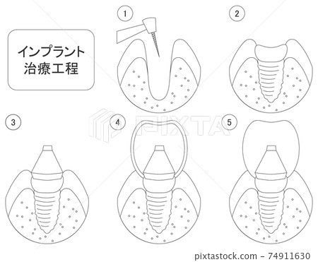 Dental implant treatment process illustration line art 74911630