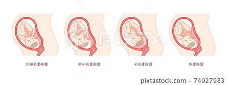 前置胎盤嬰兒和子宮 74927983