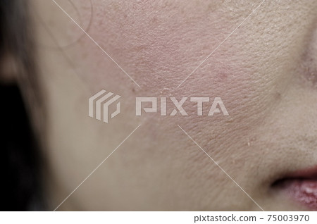 Women's skin trouble up 75003970