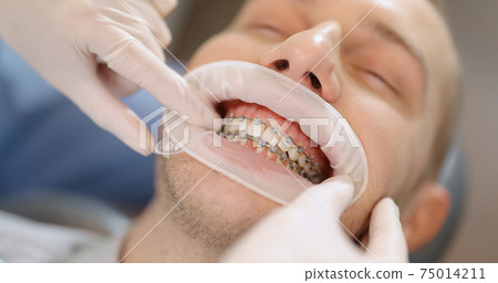 Patient with dental braces during an orthodontic treatment 75014211