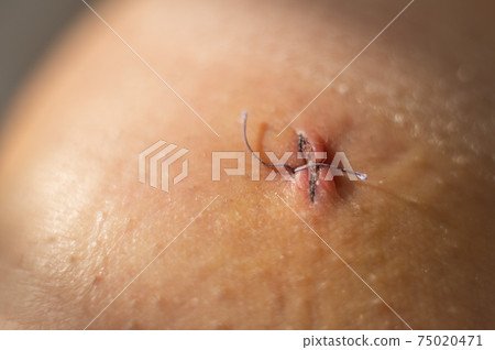 Close-up of a surgical suture after laparoscopic meniscus surgery. 75020471