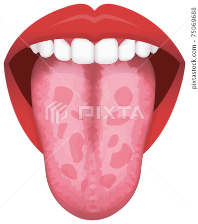 舌頭/舌苔斑駁的舌頭代表身體不適 75069688