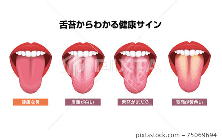 舌頭/舌頭塗層矢量插圖集表示的身體不適信號 75069694