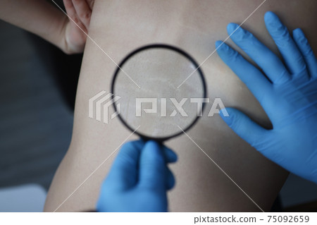 Doctor examining stretch marks on patients back using magnifying glass closeup Doctor examining stretch marks on patients back using magnifying glass closeup 75092659