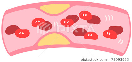 血管有斑塊 75093933