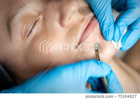 Close-up detail of beautician doctor hand in blue rubber protective gloves make blackhead spot pimples removal procedure for young adult female patient. Woman facial cleansing and skin care concept Close-up detail of beautician doctor hand in blue rubber protective gloves make blackhead spot pimples removal procedure for young adult female patient. Woman facial cleansing and skin care concept 75104827