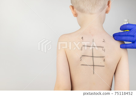An allergist in the laboratory conducts an allergy prick-test. Skin test for household, food, epidermal allergic reactions. The test is performed on the patient's back. Child at a doctor's appointment 75118452