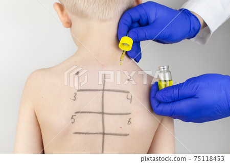An allergist in the laboratory conducts an allergy prick-test. Skin test for household, food, epidermal allergic reactions. The test is performed on the patient's back. Child at a doctor's appointment 75118453