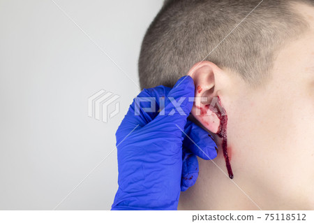 A man whose ear is bleeding. Vascular rupture, damage to the tympanic membrane, ear diseases, oncology, otitis media, myringitis A man whose ear is bleeding. Vascular rupture, damage to the tympanic membrane, ear diseases, oncology, otitis media, myringitis 75118512