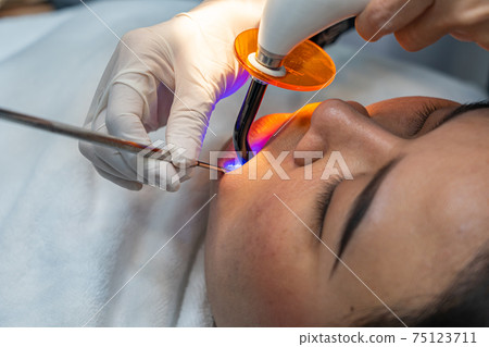 Close up photo of Asian woman having dental ultraviolet light treatment Close up photo of Asian woman having dental ultraviolet light treatment 75123711