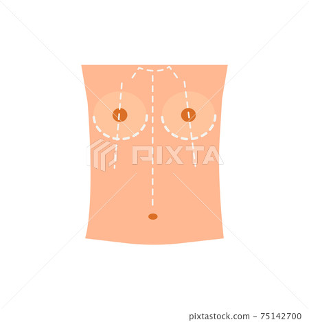 Breast Augmentation Scheme Composition 75142700