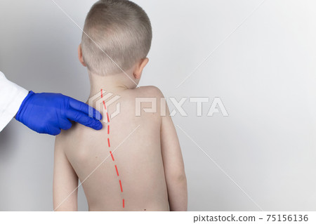 A little boy at the doctor's appointment with back pain. Treatment of spinal deformity and stoop. Osteoporosis, kyphosis, lordosis, or scoliosis. A little boy at the doctor's appointment with back pain. Treatment of spinal deformity and stoop. Osteoporosis, kyphosis, lordosis, or scoliosis. 75156136