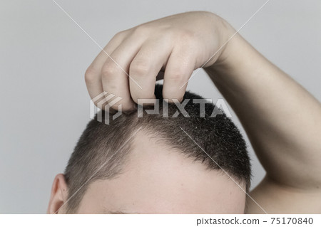 Dandruff on a man's shoulder. Side view of a man who has more dandruff flakes on his black shirt. Scalp disease treatment concept. Discomfort from a fungal infection 75170840