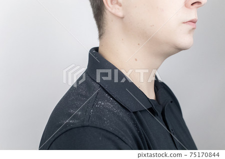 Dandruff on a man's shoulder. Side view of a man who has more dandruff flakes on his black shirt. Scalp disease treatment concept. Discomfort from a fungal infection 75170844