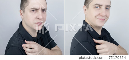 Dandruff before and after. The man on the left shows his shoulder, which has a lot of dandruff. In the photo on the right, the problems with the scalp fungus have disappeared and the man is happy. Dandruff before and after. The man on the left shows his shoulder, which has a lot of dandruff. In the photo on the right, the problems with the scalp fungus have disappeared and the man is happy. 75170854