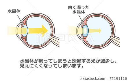 Illustrated explanation of cataract 75191116