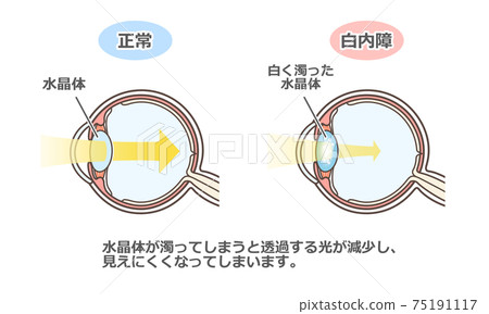 Illustrated explanation of cataract 75191117