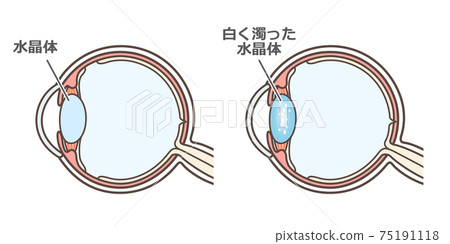 Illustrated explanation of cataract 75191118