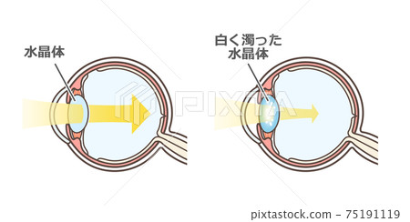 Illustrated explanation of cataract 75191119