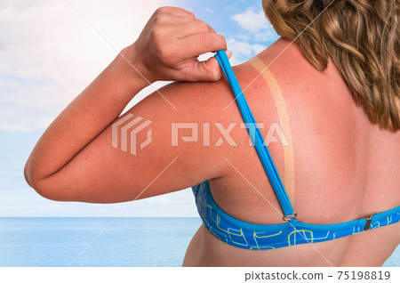 Woman with red sunburned shoulder - sunburn concept Woman with red sunburned shoulder - sunburn concept 75198819
