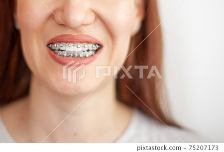 The smile of a young girl with braces on her white teeth. Teeth straightening. 75207173