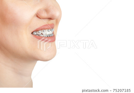 The smile of a young girl with braces on her white teeth. Teeth straightening. The smile of a young girl with braces on her white teeth. Teeth straightening. 75207185
