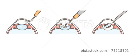 Illustration of cataract surgery 75218501