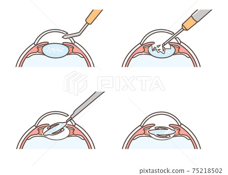 Illustration of cataract surgery 75218502