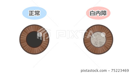 Cataract black eyes 75223469