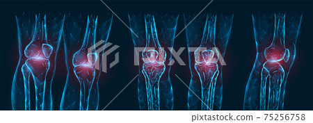 Pain, injury or inflammation in the knees polygonal vector illustration. Low poly model of sore knee joints. 75256758
