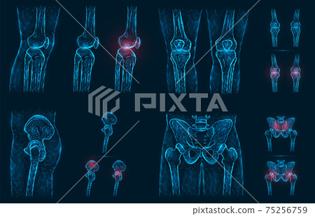 Pain, injury or inflammation in the knees and pelvis polygonal vector illustration. Low poly model of a sore knee, hip and hip joint. Pain, injury or inflammation in the knees and pelvis polygonal vector illustration. Low poly model of a sore knee, hip and hip joint. 75256759