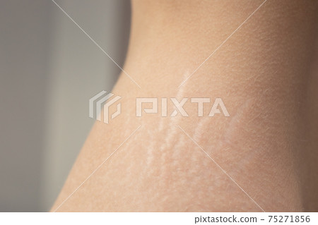 Visible stretch marks on Woman hips 75271856