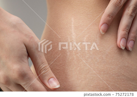 Woman hips with visible stretch marks. Young woman showing Stretch mark scars on her body 75272178